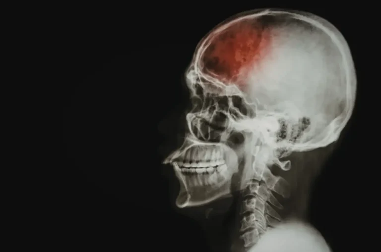 Brain Injury